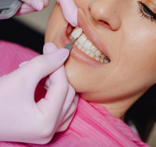 Detailed shot of a dentist applying veneer to a woman's teeth during a dental procedure.